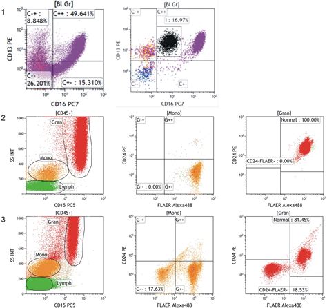 Leukemia/Lymphoma Phenotyping Evaluation by Flow .